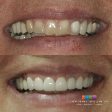 Before and after smile makeover at Creative Dentistry & Medspa in Covington, GA showing brighter, more even teeth.