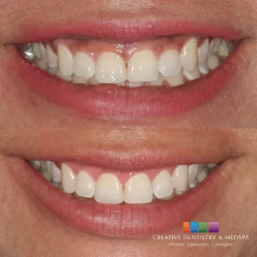 Gum bleaching before and after